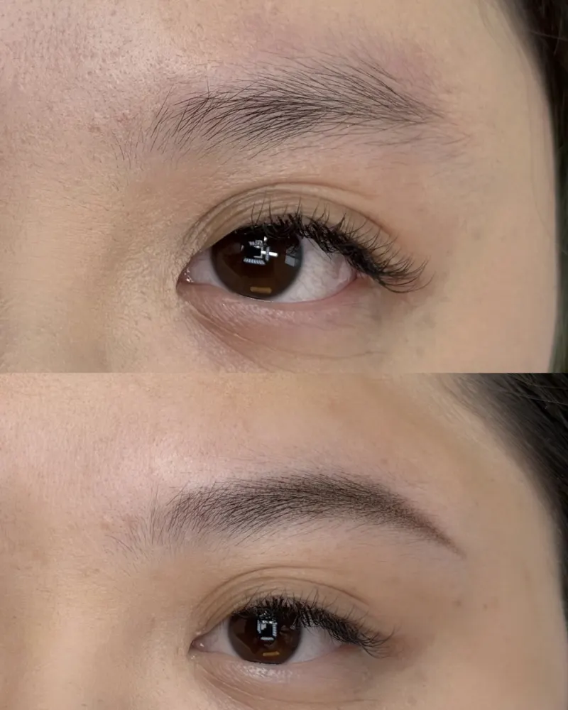 蒲欣老师雾眉案例 1
