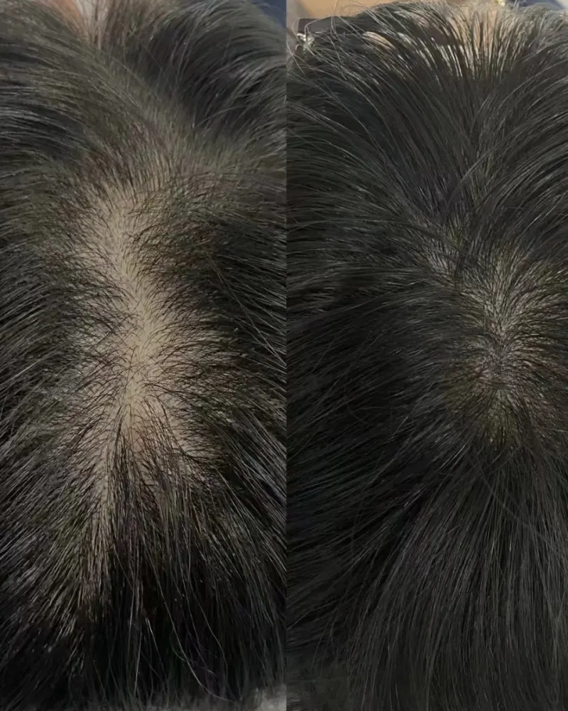 蒲欣老师纹发发缝填补案例 2