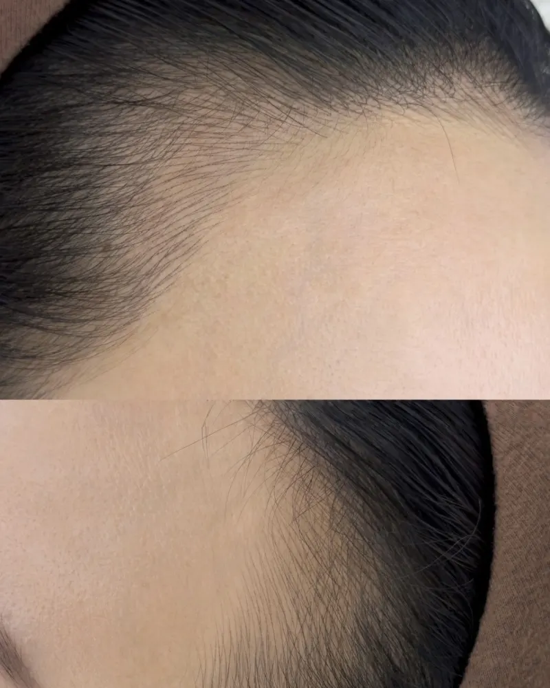 蒲欣老师纹发发际线案例 2